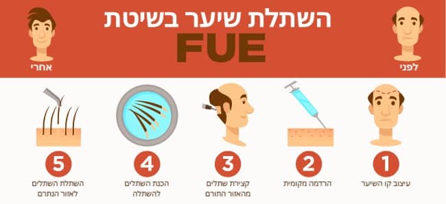 המחשה של השתלת שיער FUE