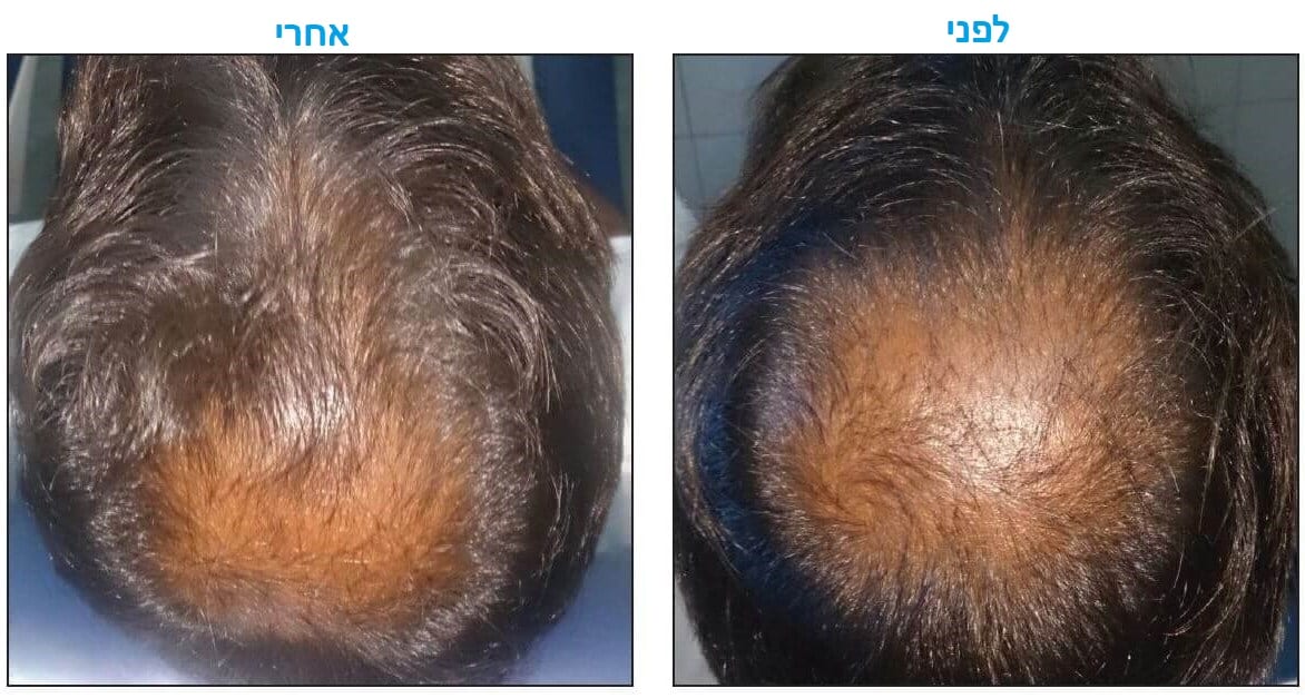 טיפול בנשירת שיער באמצעות פלזמה עשירה בטסיות לפני ואחרי