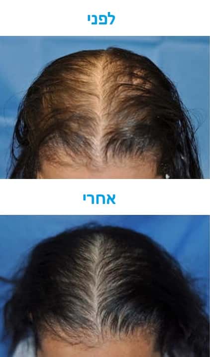 טיפול בנשירת שיער עם לייזר תמונה של לפני ואחרי