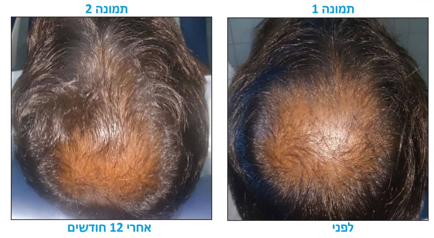טיפול PRP לשיער לפני ואחרי