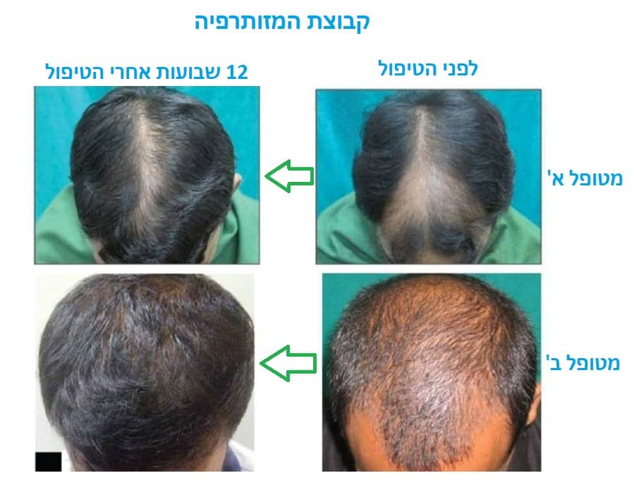 לפני ואחרי טיפול בנשירת שיער עם מזותרפיה ומינוקסידיל