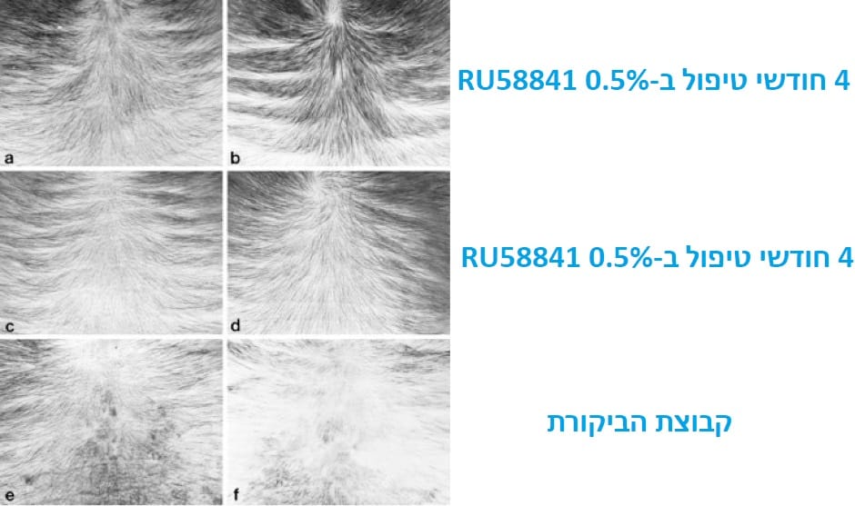טיפול בנשירת שיער - תוצאות המחקר של RU58841 אחרי 4 חודשים