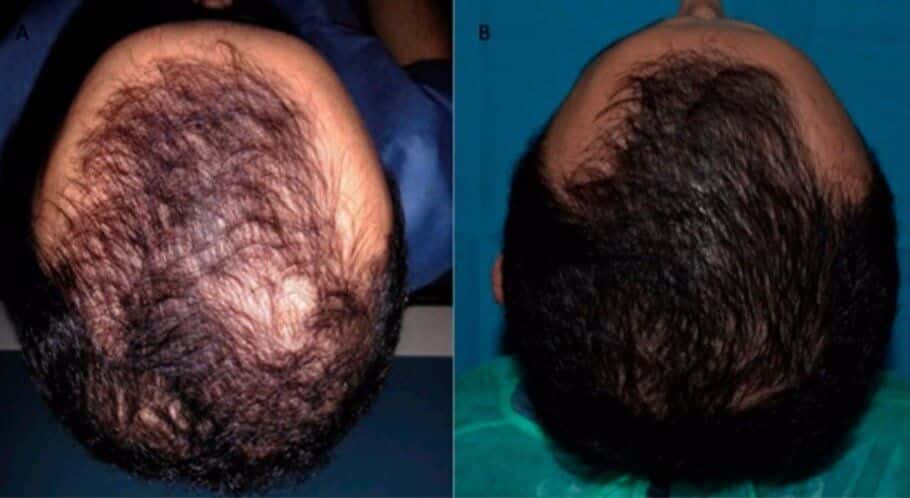 תוצאות לפני ואחרי של הניסוי האיטלקי של טיפול PRP לשיער גברי