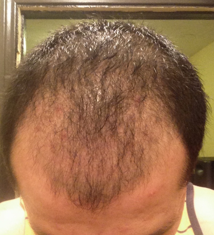תופעת לוואי של דלקת זקיק השיער אחרי השתלת שיער