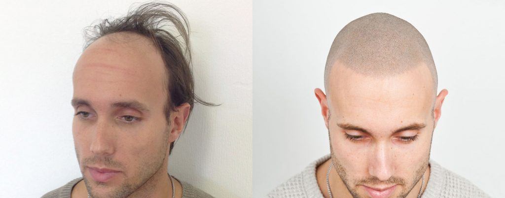 הדמיית שיער לפני ואחרי גבר לבן עם קוקו