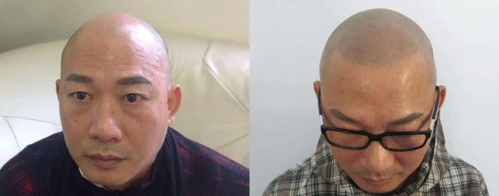 הדמיית שיער על גבר אסייתי לפני ואחרי