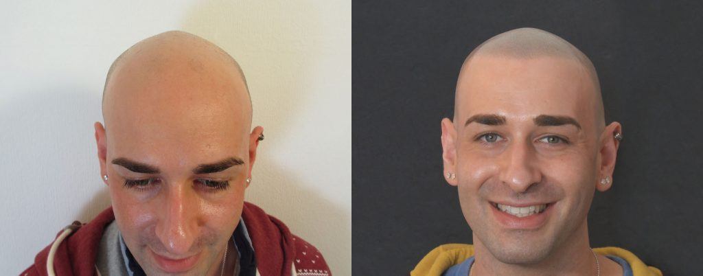 הדמיית שיער על גבר לבן עם עגילים באוזניים לפני ואחרי