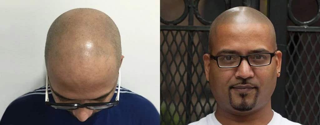 תמונה לפני ואחרי של הדמיית שיער על גבר שחור