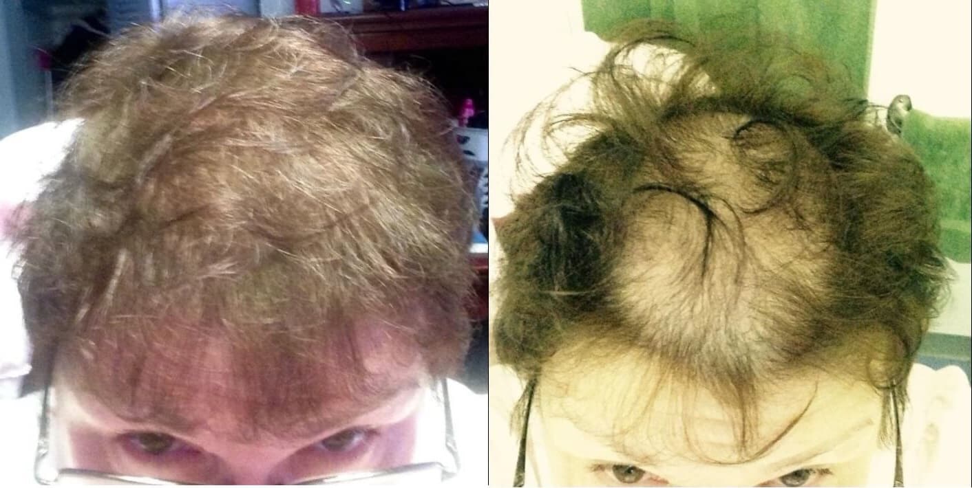 טופיק לשיער תמונה של לפני ואחרי על אישה
