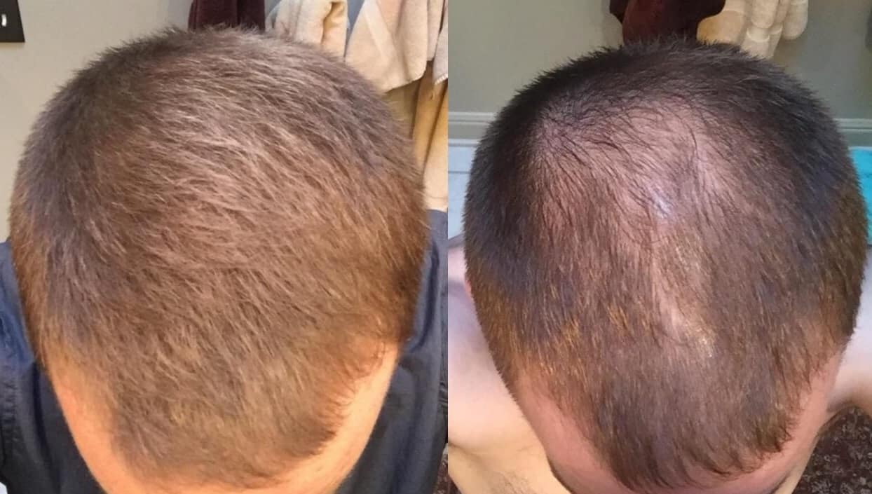טופיק לשיער תמונה של לפני ואחרי על גבר