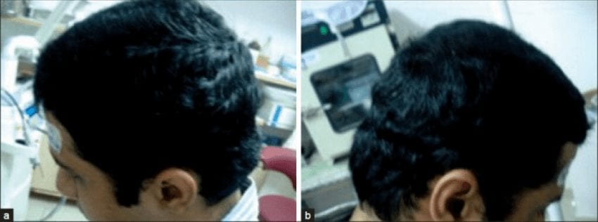 תמונה של גבר אחרי שלושה טיפולים של מזותרפיה לשיער