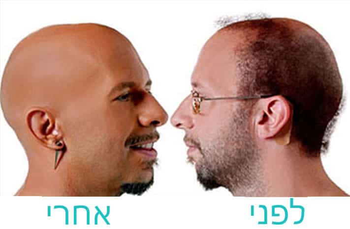 ניל שטראוס לפני ואחרי