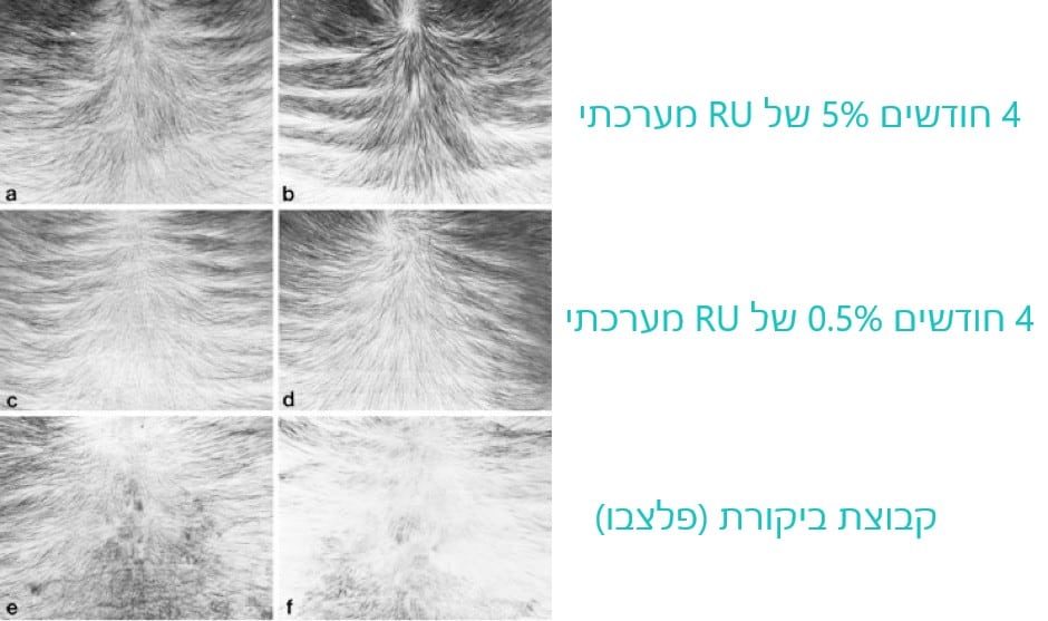 תוצאות הניסוי המערכתי של RU58841 אחרי 4 חודשים