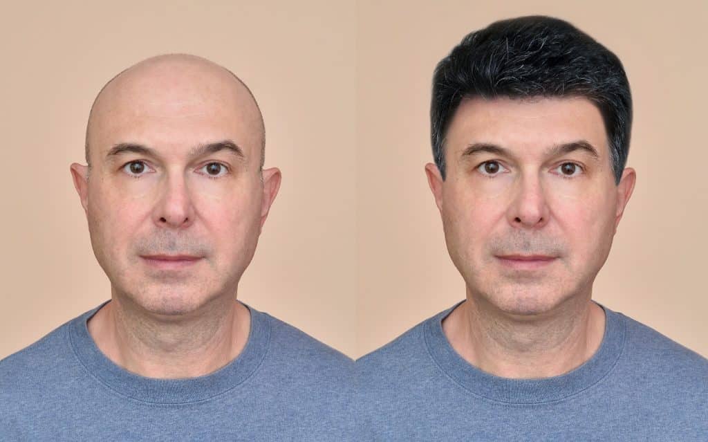 לפני ואחרי של גבר שעבר השתלת שיער