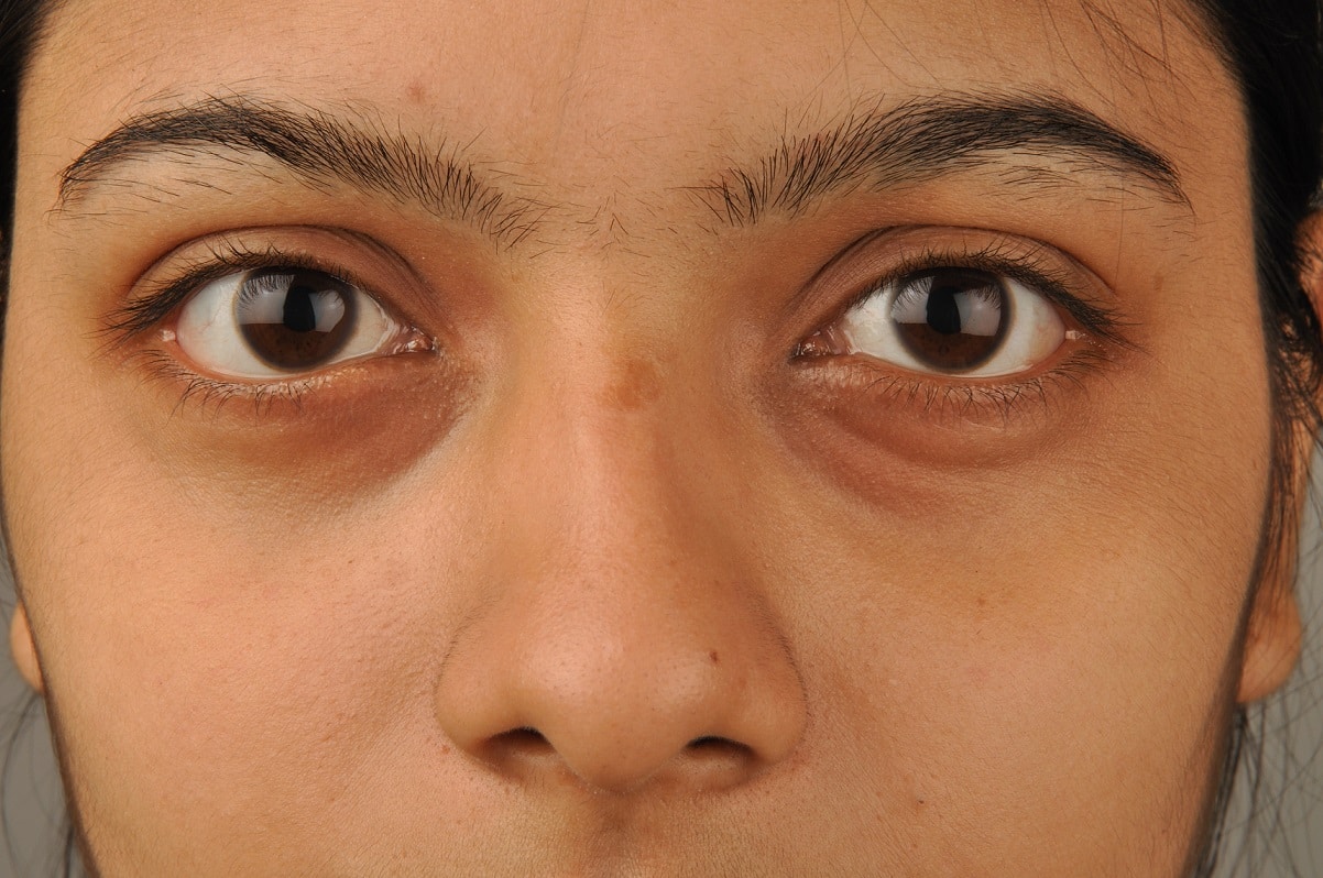 אישה עם עיגולים שחורים מתחת לעיניים