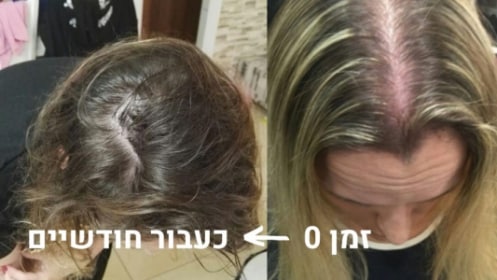 ענת לפני ואחרי HR Growth