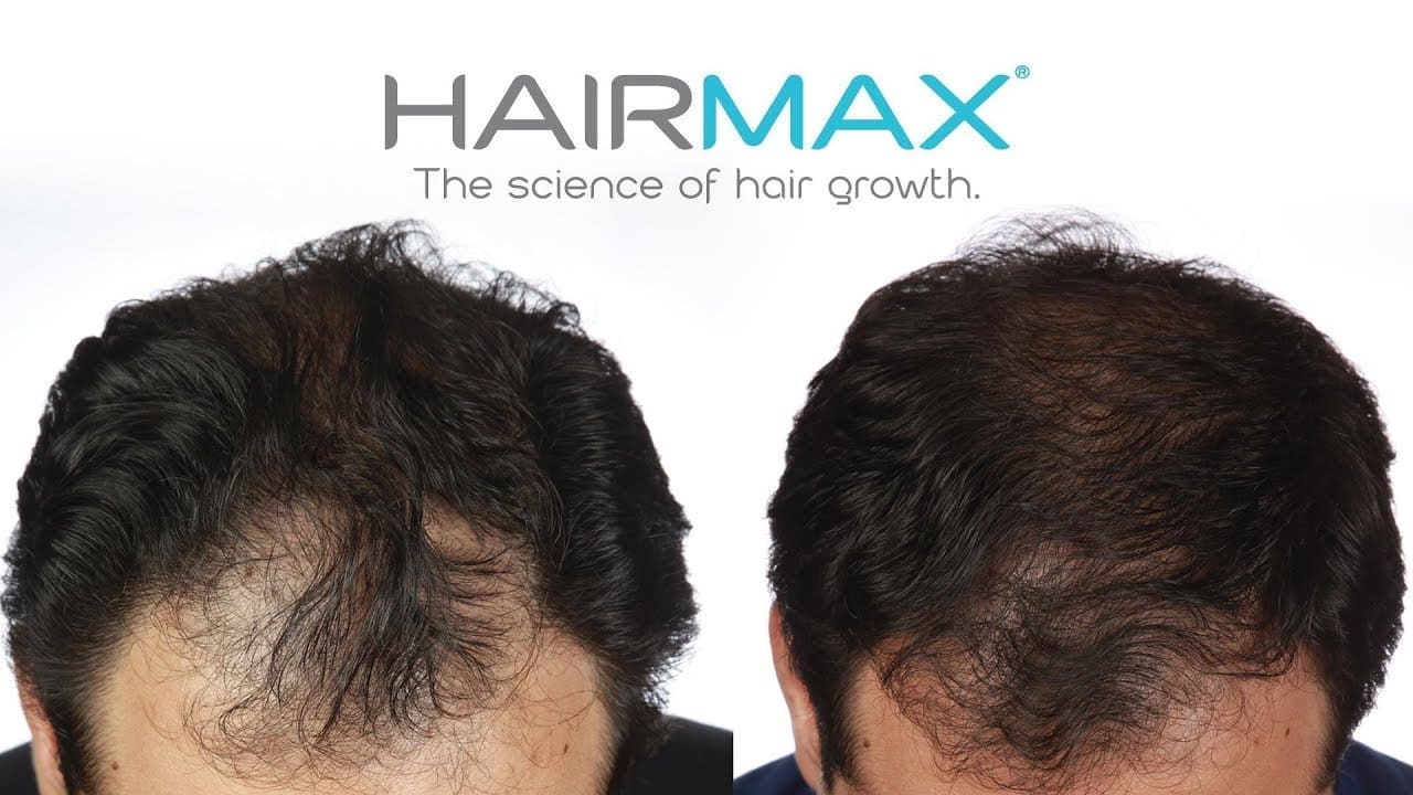 היירמקס hairmax