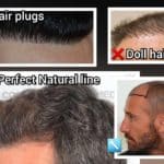 ההבדלים בין השתלת שיער מושלמת לבין השתלת שיער כושלת