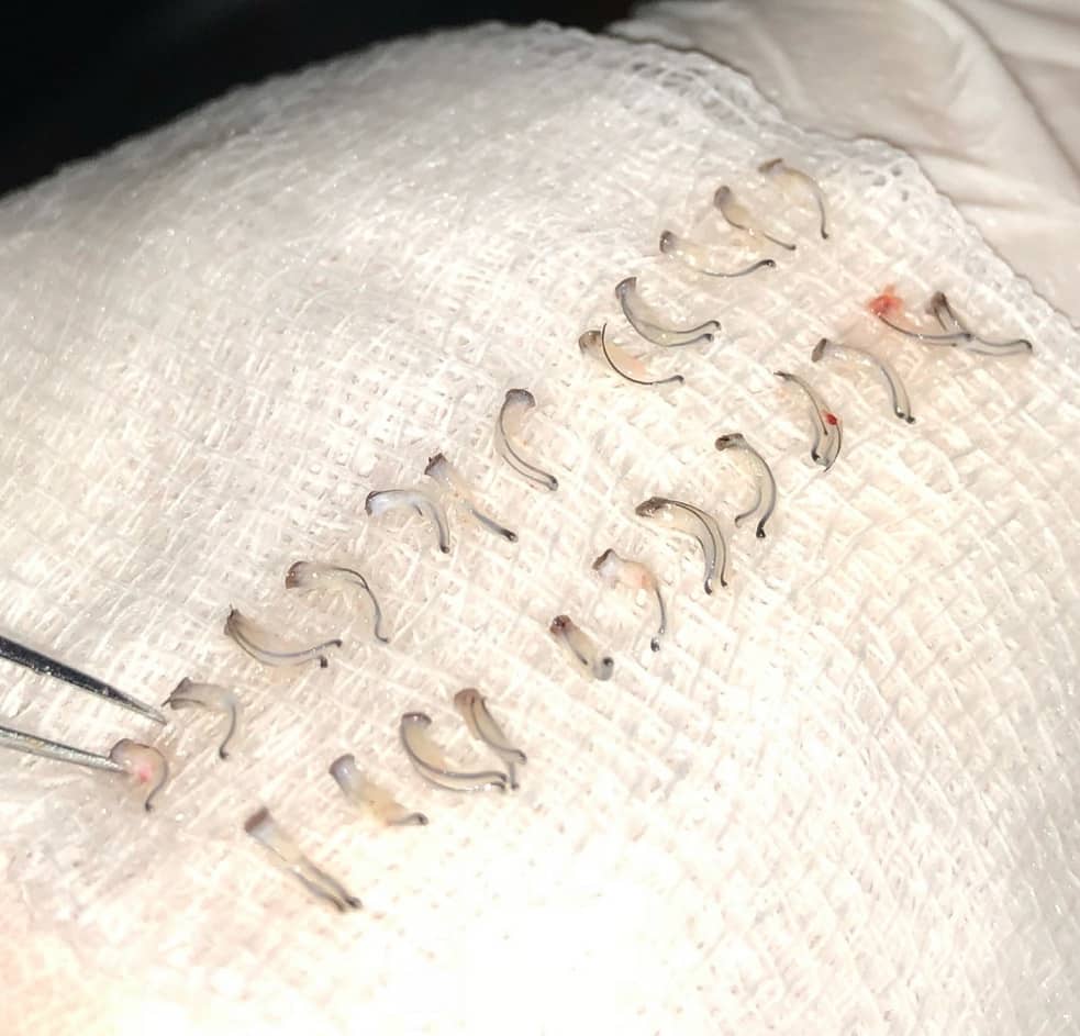 זקיקים מרובי שיער על מטלית במרפאה של השתלת שיער בטורקיה