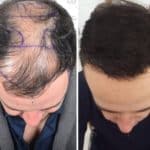 תוצאות של השתלת שיער בטורקיה אחרי 9 חודשים
