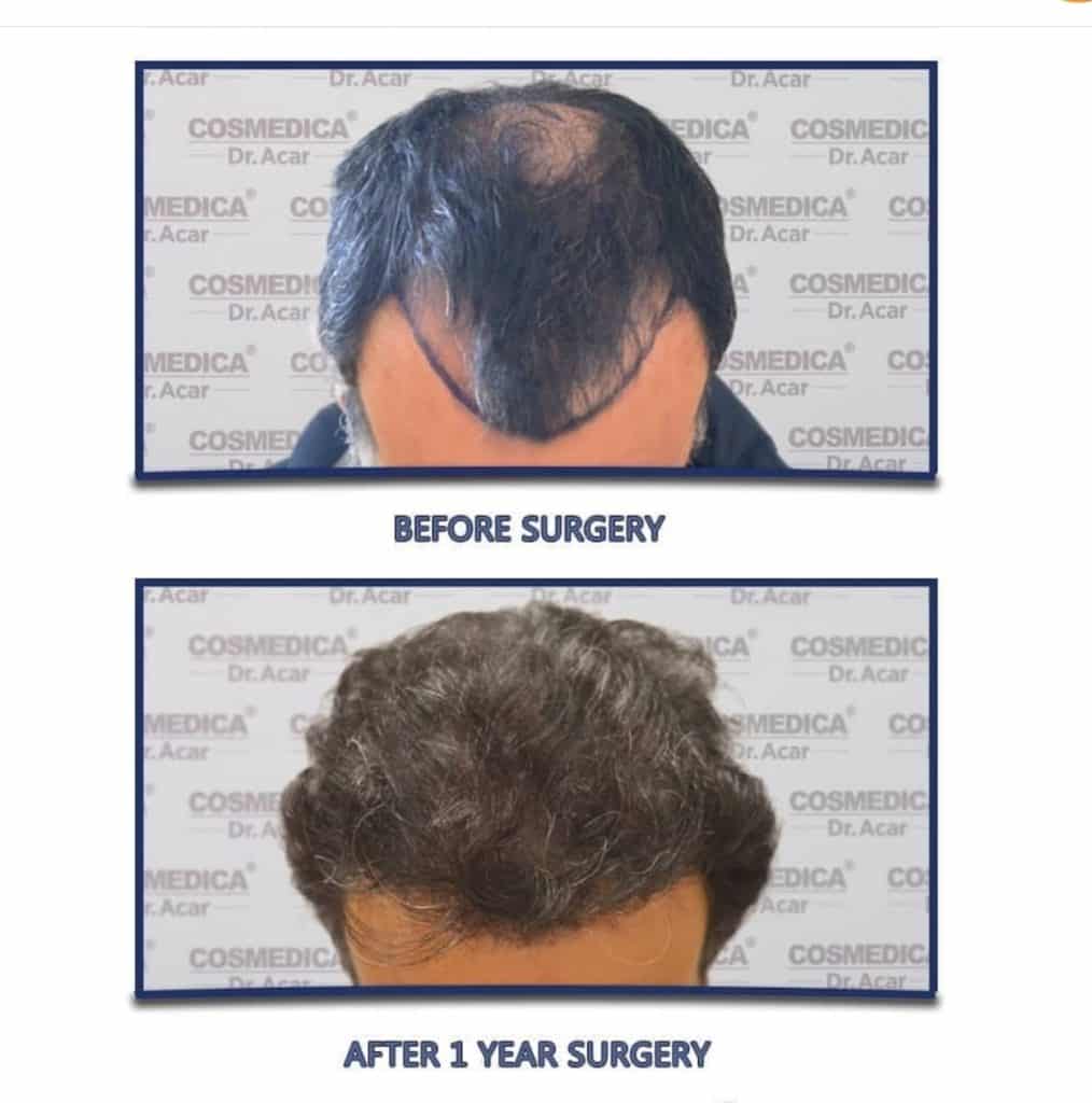 תוצאות של השתלת שיער בטורקיה לפני ואחרי שנה במטופל