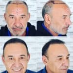 תמונה לפני ואחרי של גבר השתלת שיער בטורקיה שיער מאפיר