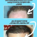 ההבדלים בין השתלת שיער מושלמת לבין השתלת שיער כושלת