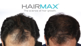 היירמקס: המדריך המלא על מוצרי חברת HairMax