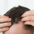 חומצה פולית לטיפול בנשירת שיער: האם זה באמת עובד?